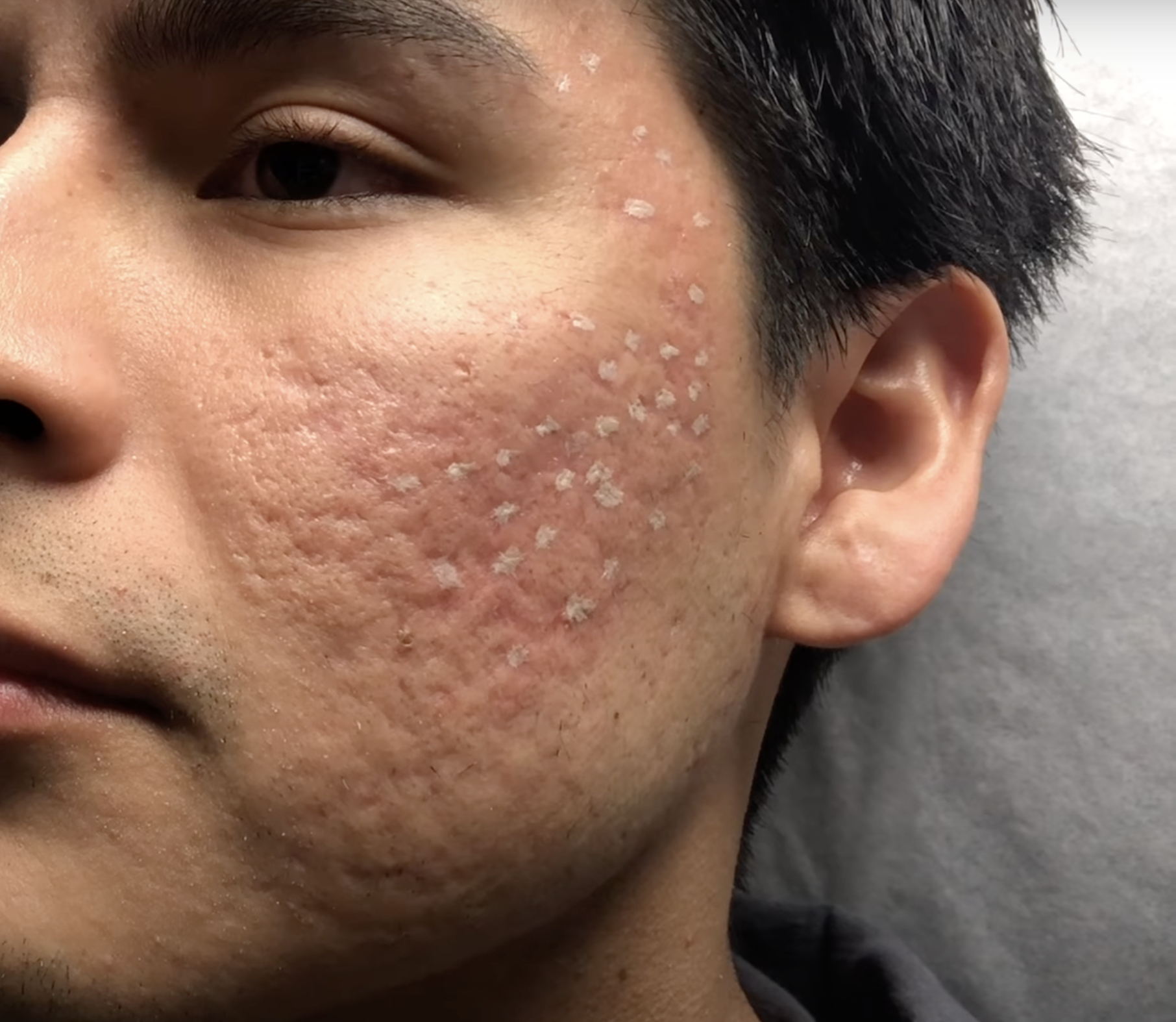 Medizinisches Peeling bei oberflächlichen Pigmentflecken