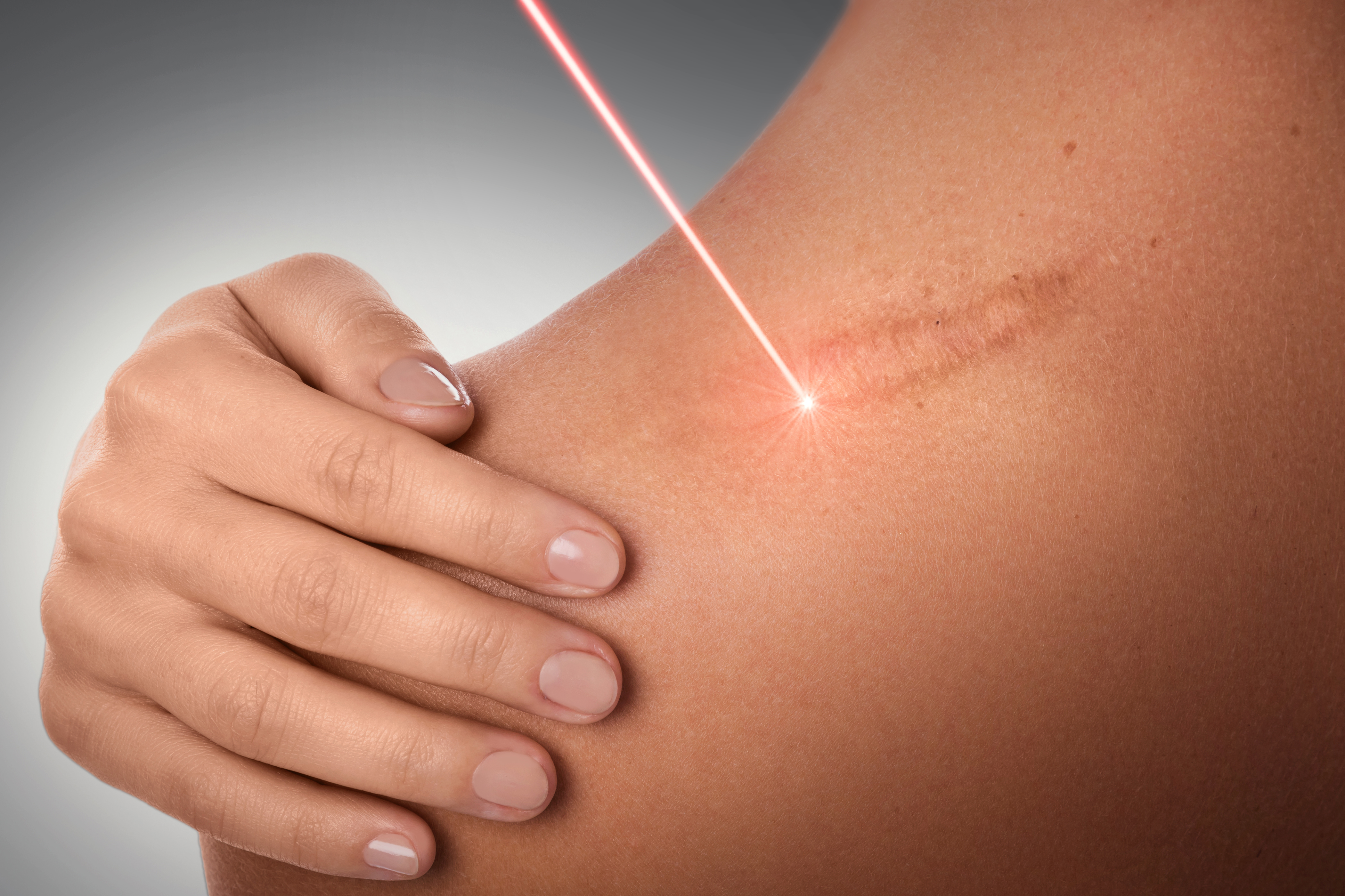 Konservative Narbenkorrektur mit Laser und dermatologischen Verfahren