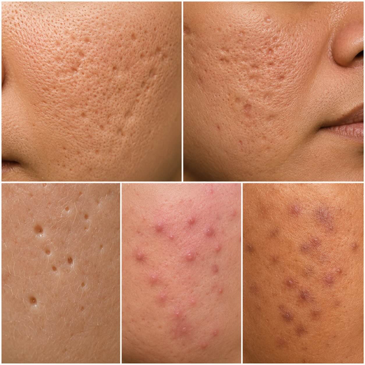 Atrophische und eingesunkene Narbenformen dermatologisch einordnen