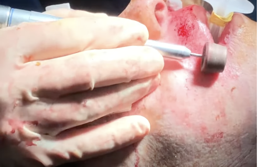 Dermabrasion zur physikalischen Hautglättung