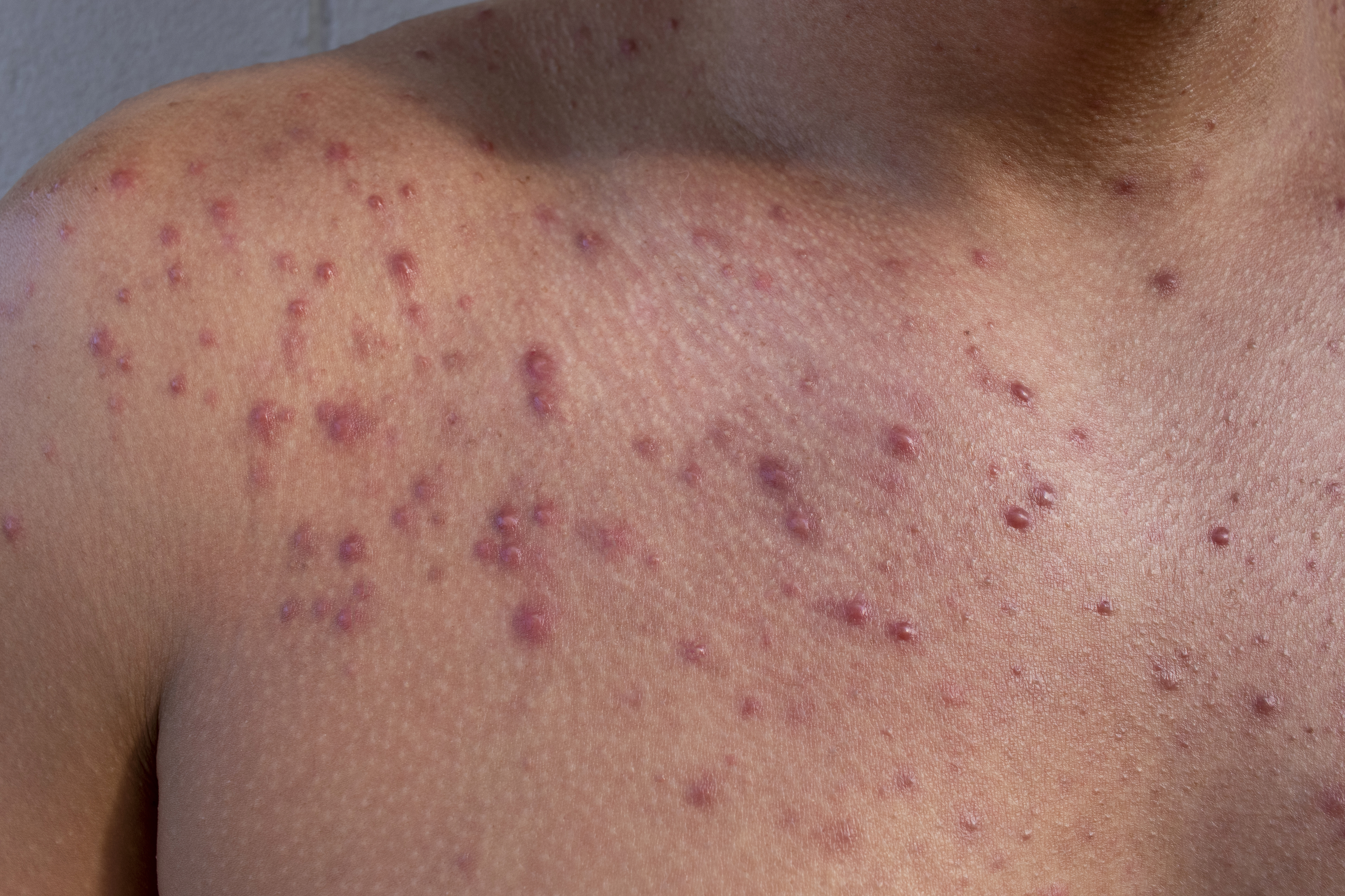 Hypertrophe verdickte Narben vor dermatologischer Behandlung