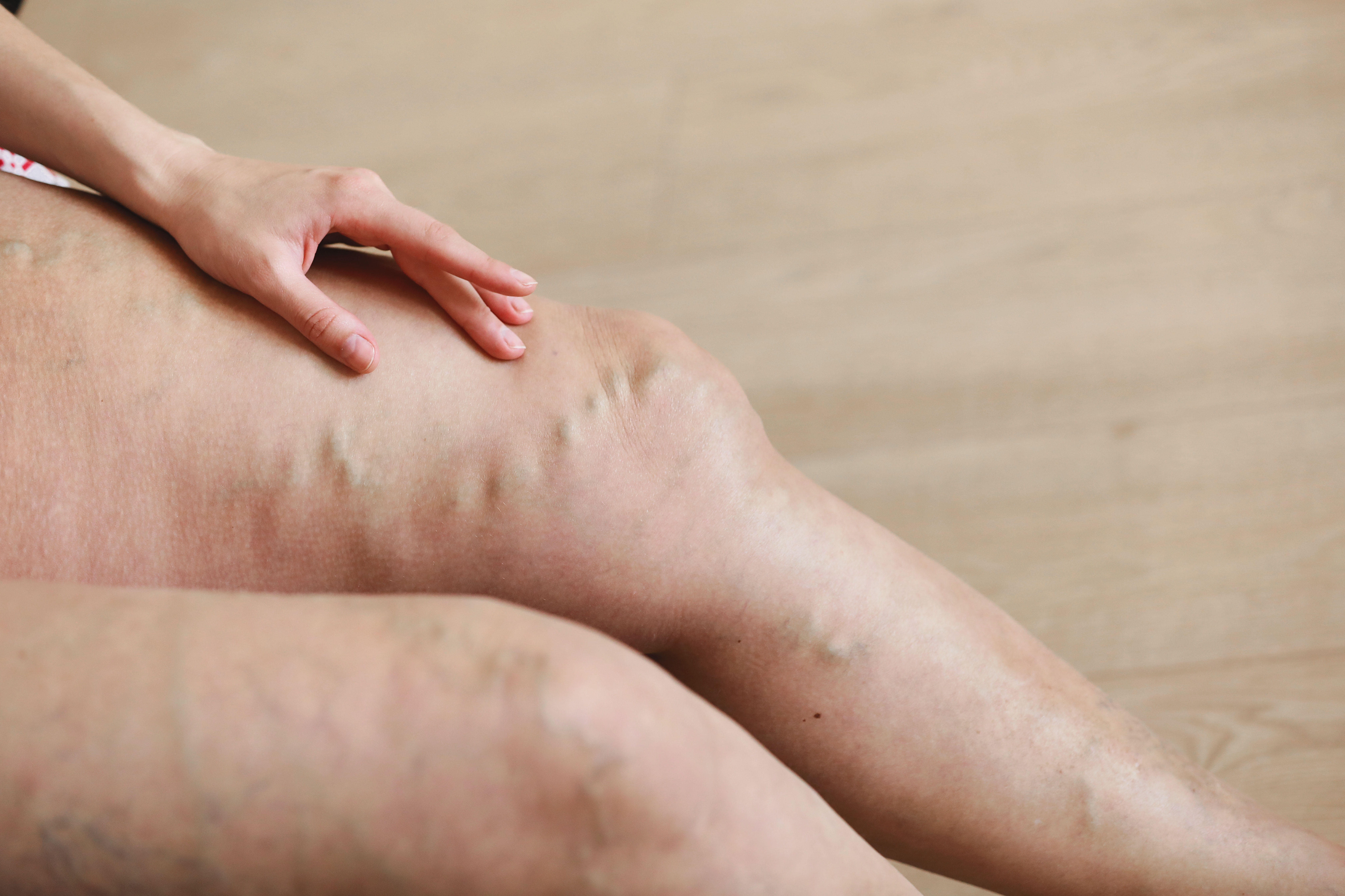 Krampfadern Behandlung und Venendiagnostik in Hanau