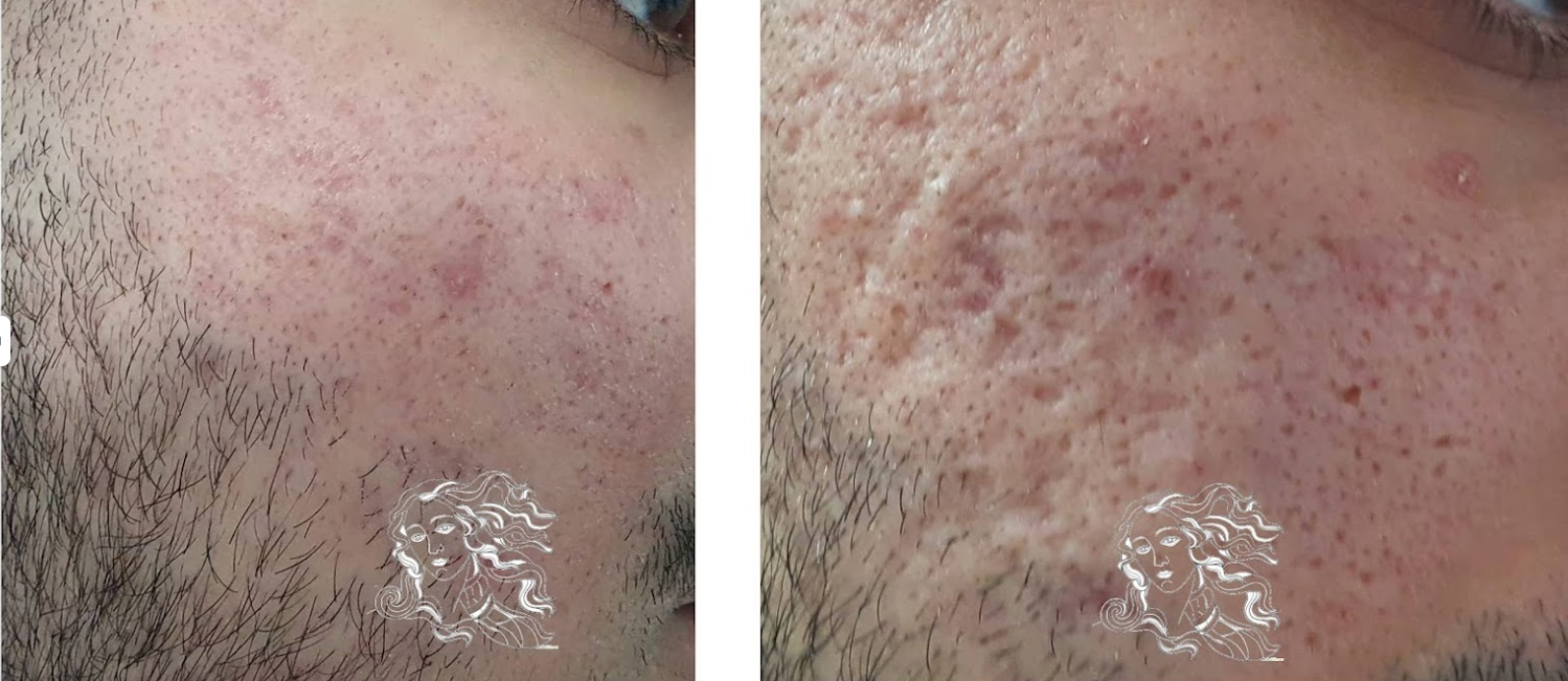 Akne Narben Pico Laser Vorher Nachher Dermatologie Hanau