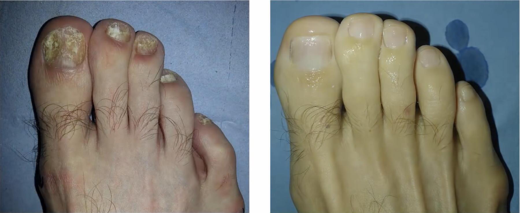 Behandlungsbeispiel Um Vorher Nachher Dermatologie Hanau