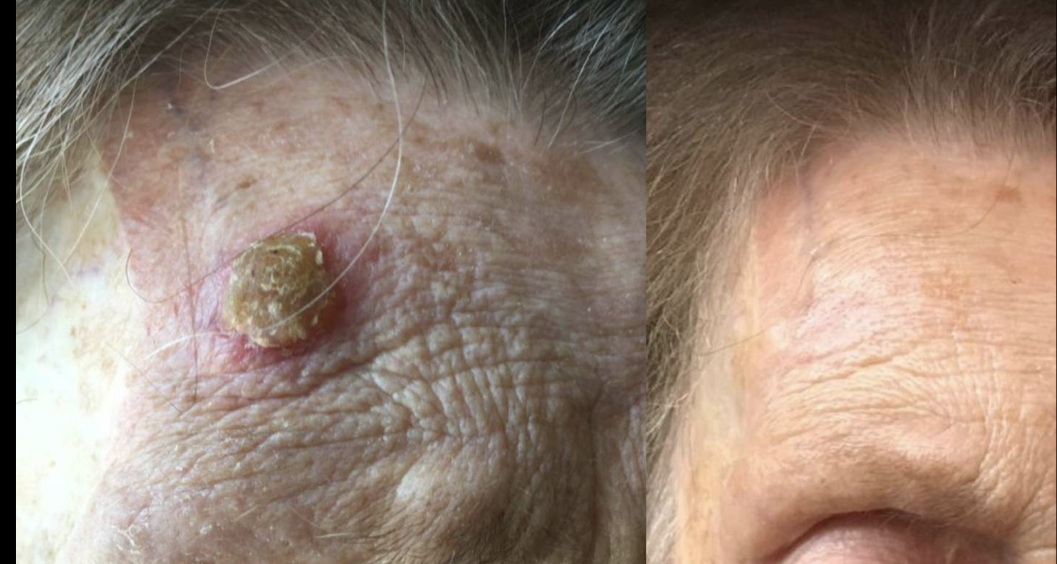 Haut Tumore Mit CO2 Laser Vorher Nachher Dermatologie Hanau
