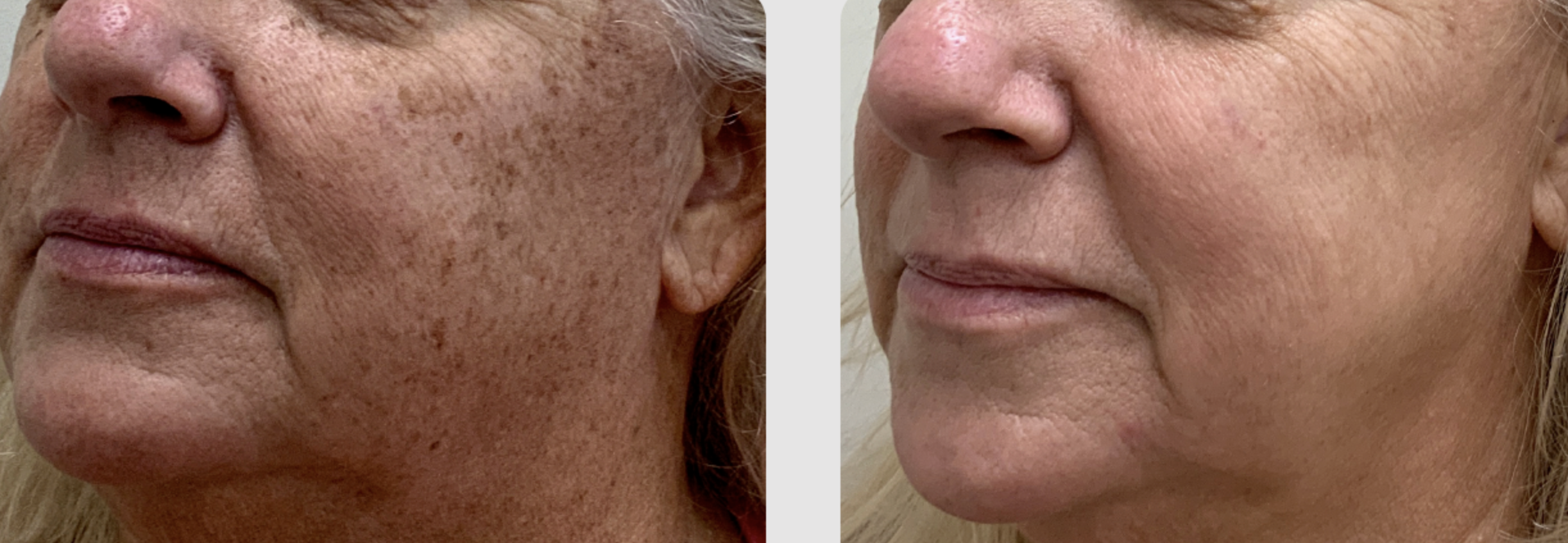 Hautbild Verbesserung1 Vorher Nachher Dermatologie Hanau