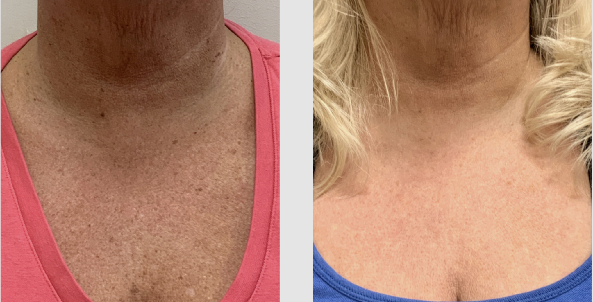 Hautbild Verbesserung3 Vorher Nachher Dermatologie Hanau