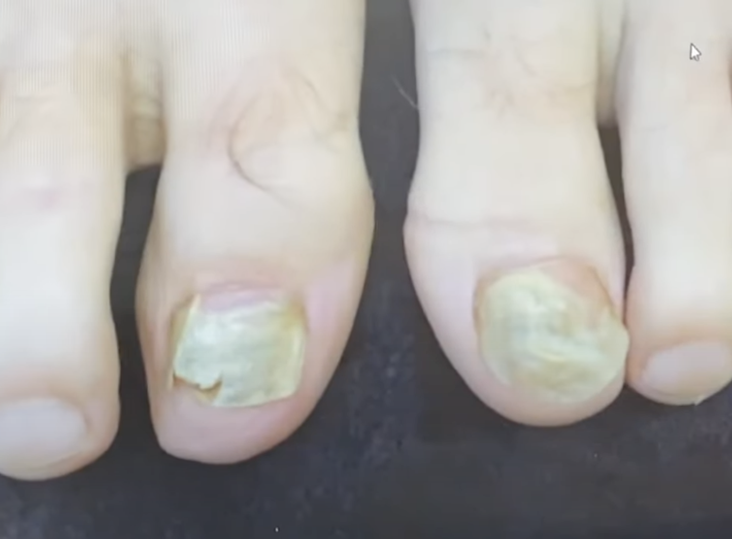 Nagelpilz Laser Verlauf