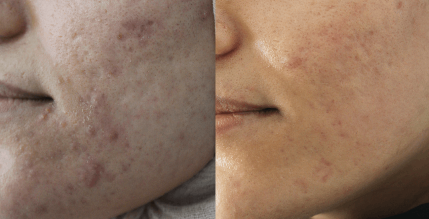 Akne Narben Foto Vorher Nachher Dermatologie Hanau