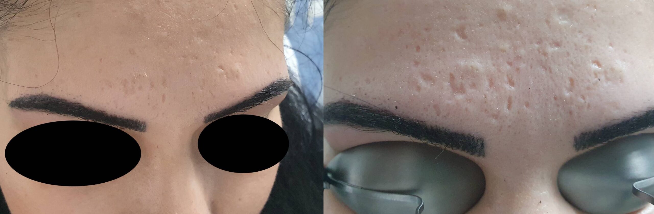 AkneNarben Behandlung Vorher Nachher Dermatologie Hanau