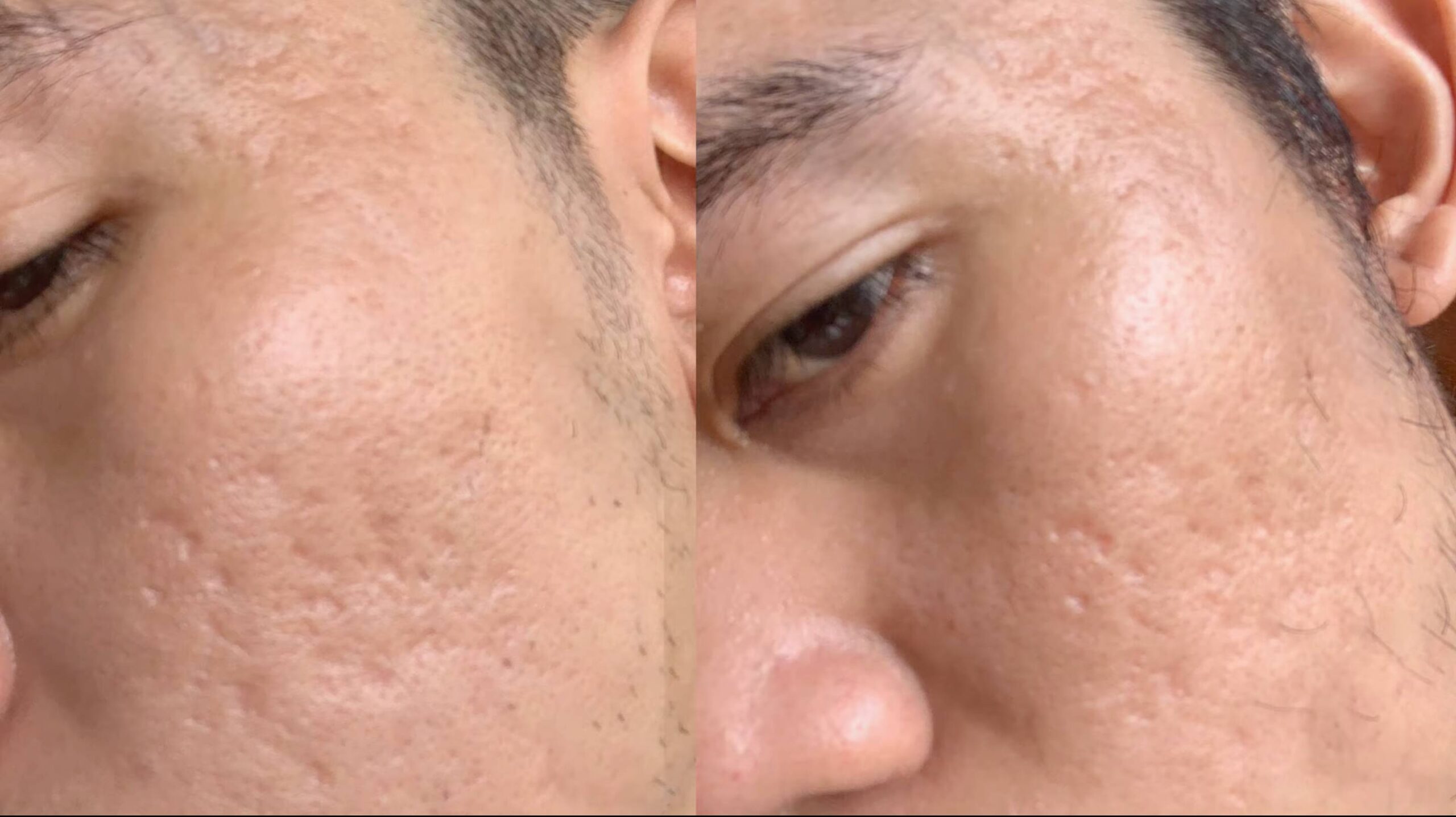 AkneNarben CO2 Laser Behandlung Vorher Nachher Dermatologie Hanau
