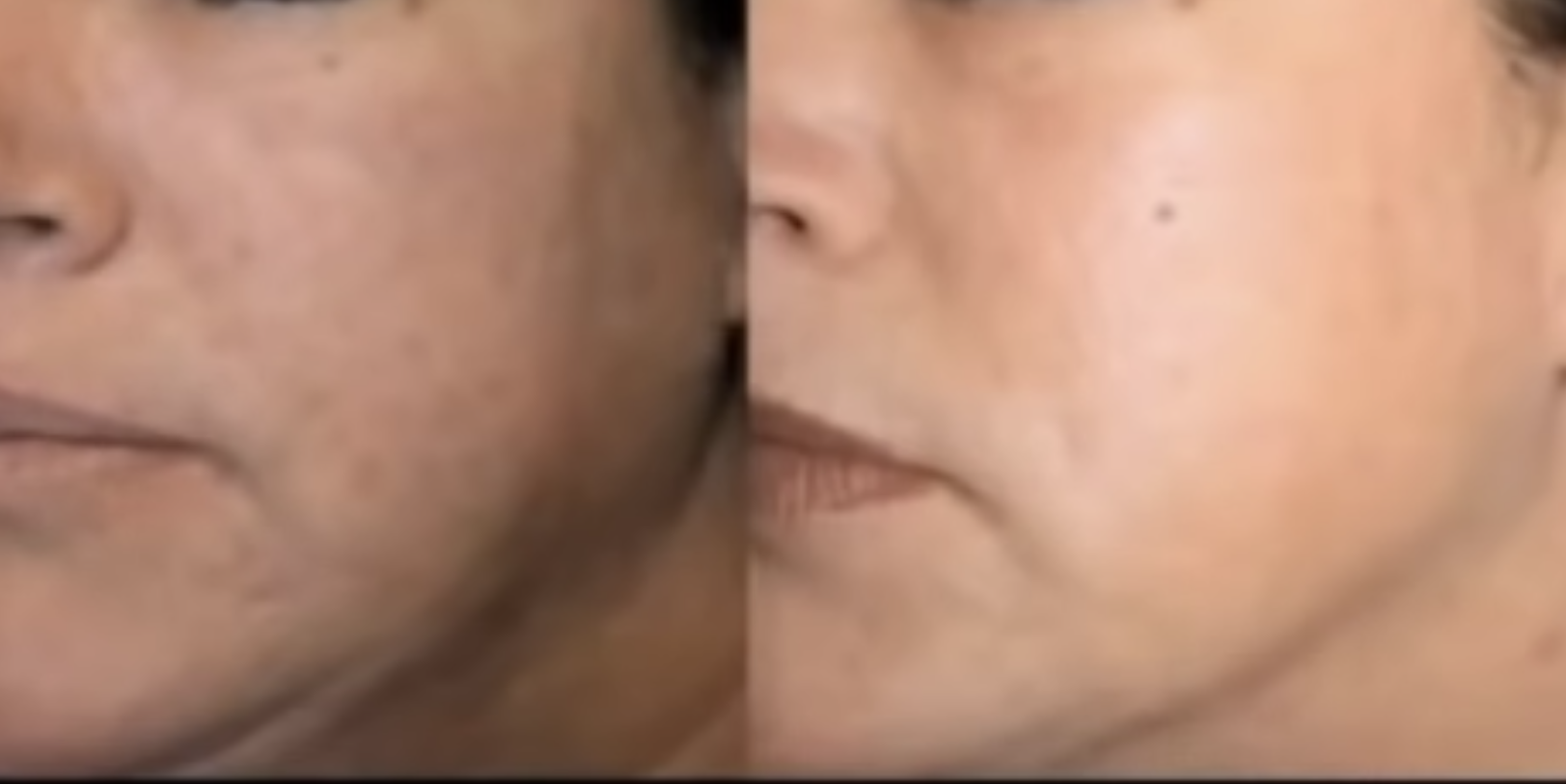 Laser Hautabtragung1 Vorher Nachher Dermatologie Hanau