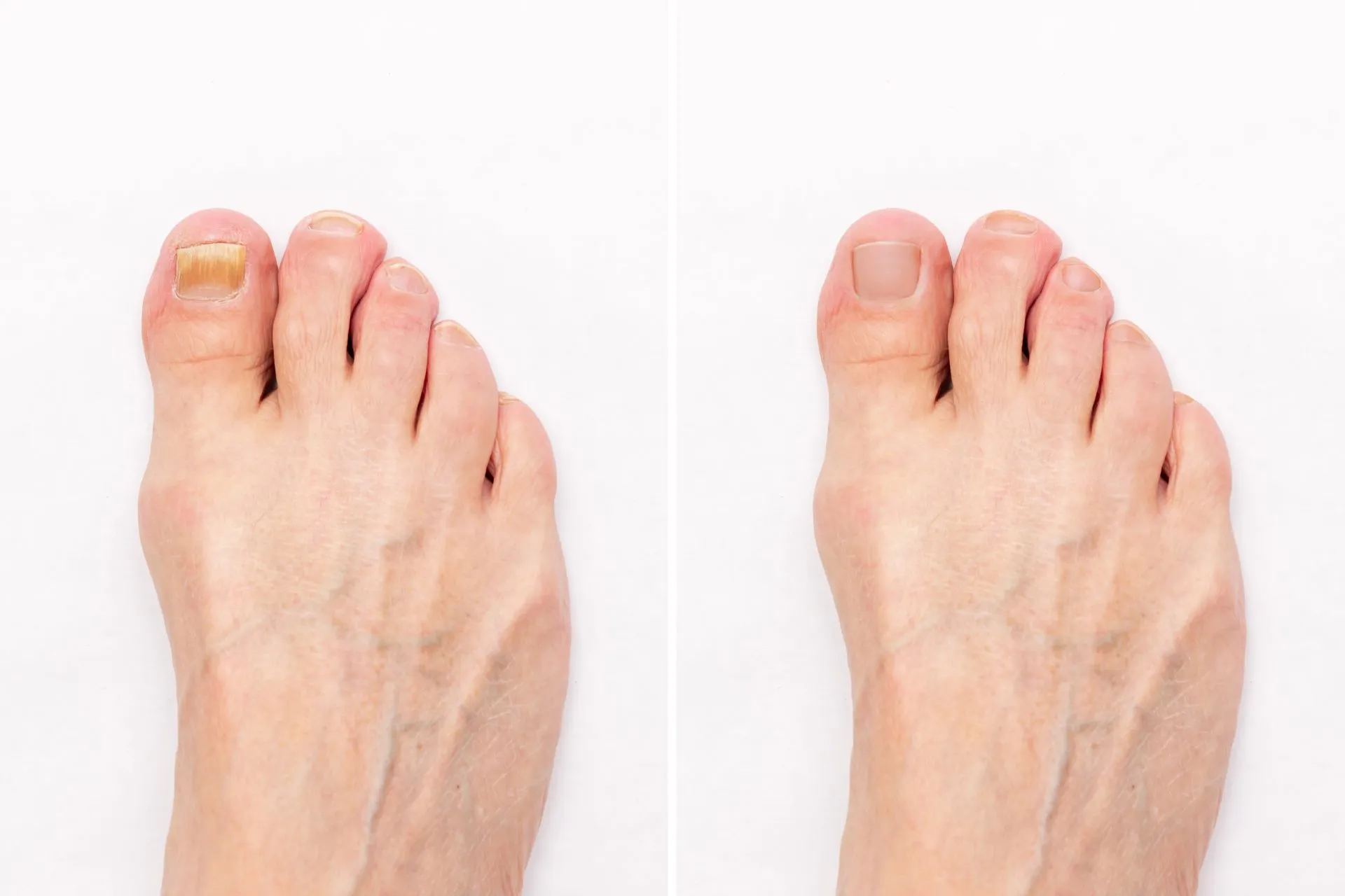 Nagel Pilz Vorher Vorher Nachher Dermatologie Hanau