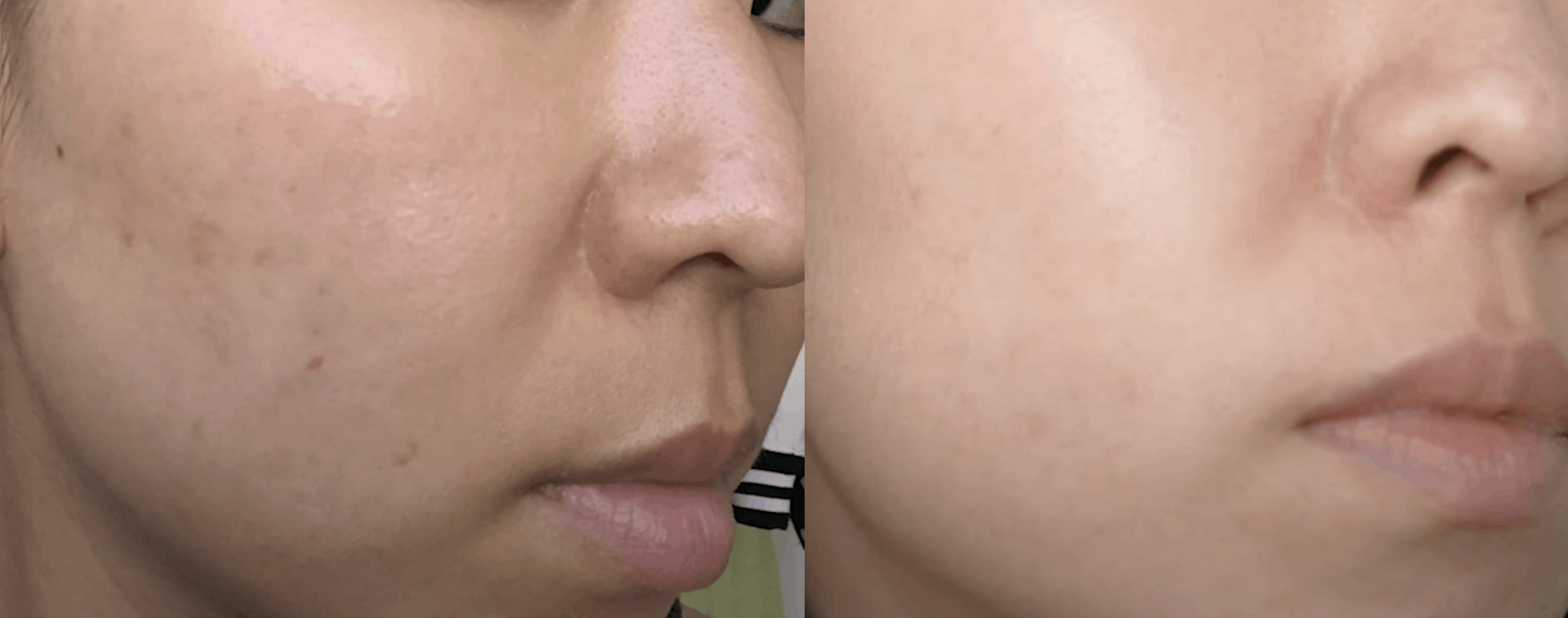 Pico Hautbildverbesserung Vorher Nachher Dermatologie Hanau
