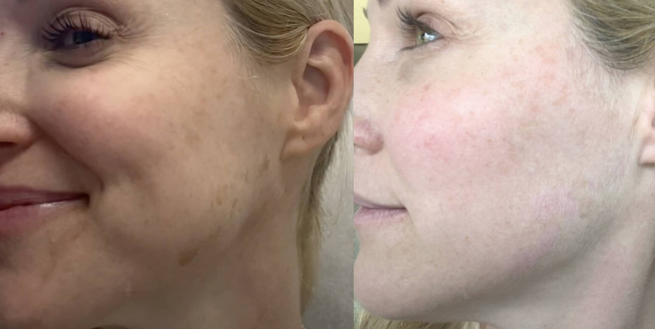 Pico Laser Hautverjuengung Vorher Nachher Dermatologie Hanau