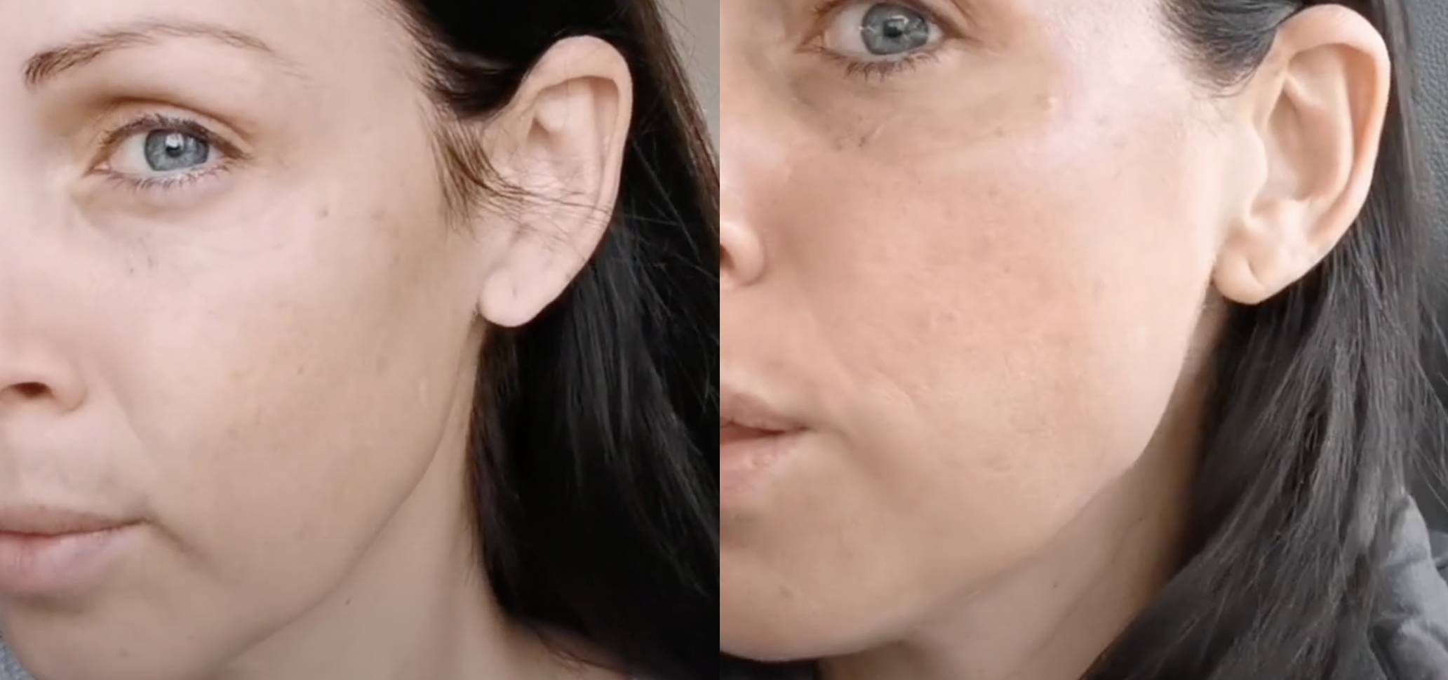 Pico Verjuengung Vorher Nachher Dermatologie Hanau