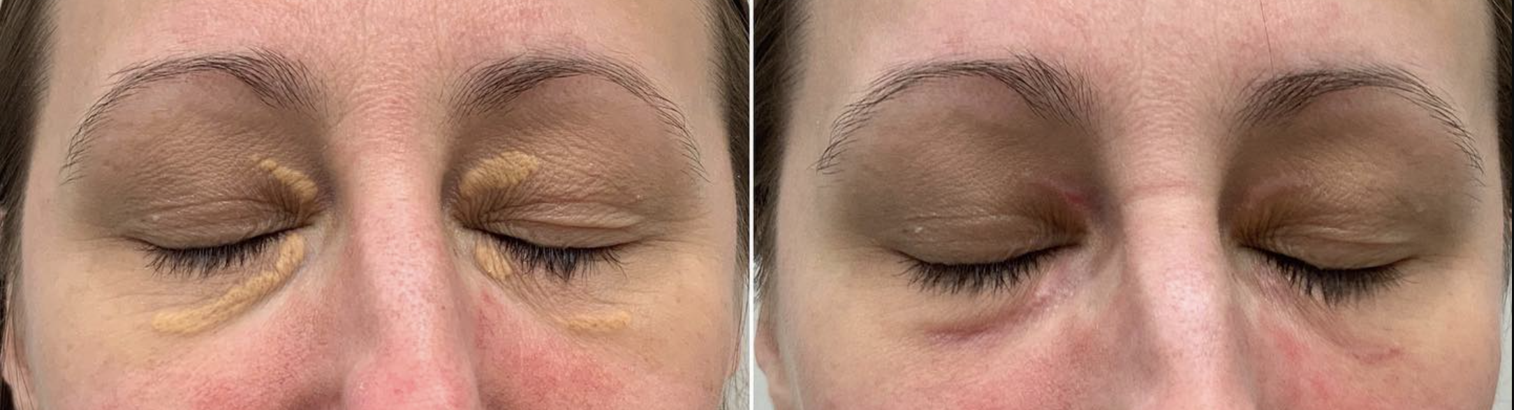 Xanthelasmen Entfernen Vorher Nachher Dermatologie Hanau