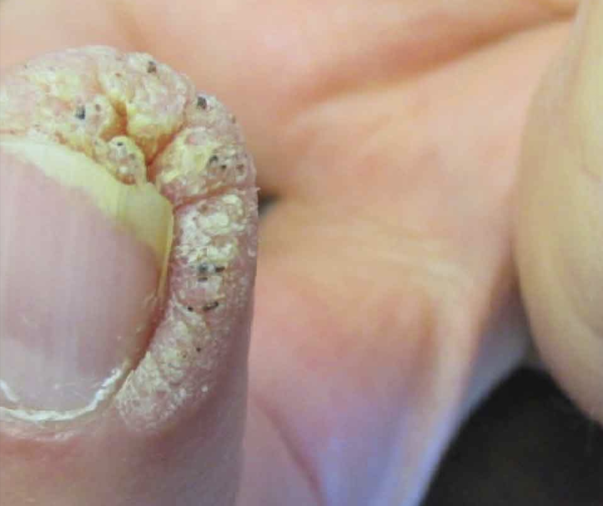 Warzen im Nagelbereich vor dermatologischer Behandlung in Hanau Warzen im Nagelbereich vor dermatologischer Behandlung in Hanau