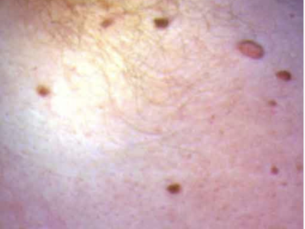 Gewöhnliche Warzen an der Haut vor dermatologischer Behandlung in Hanau Gewöhnliche Warzen an der Haut vor dermatologischer Behandlung in Hanau